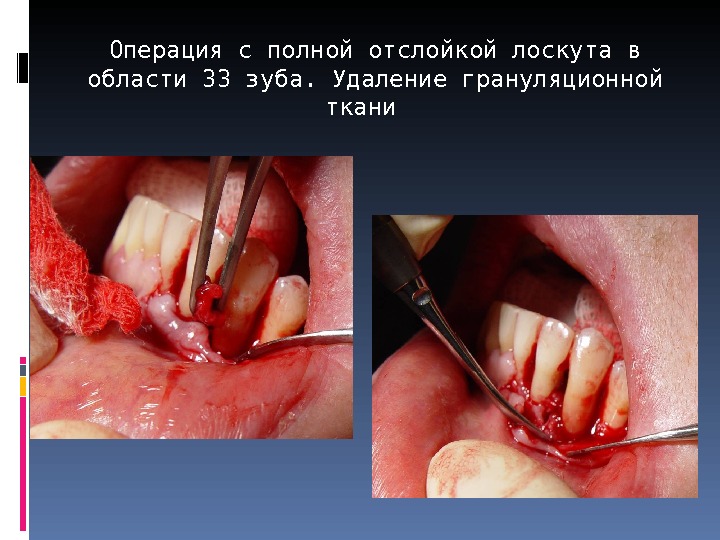 Операция с полной отслойкой лоскута в области 33 зуба.  Удаление грануляционной ткани  