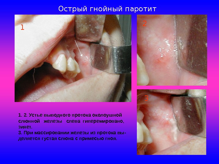 Анатомия слюнных желез Воспалительные заболевания слюнных желез