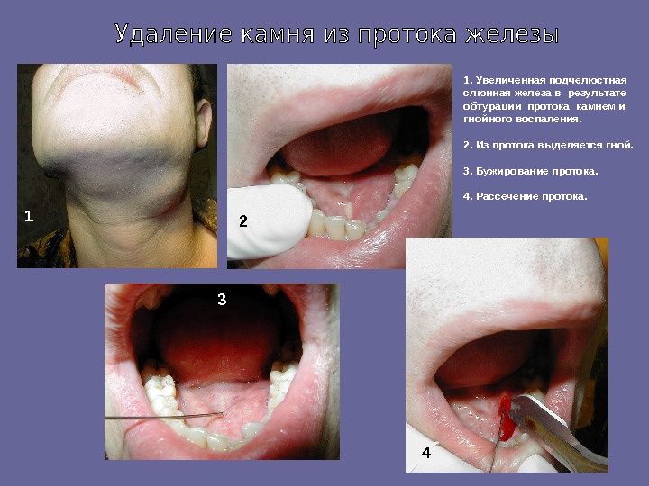 Анатомия слюнных желез Воспалительные заболевания слюнных желез