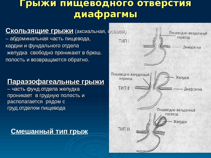 Диета При Варикозном Расширении Пищевода