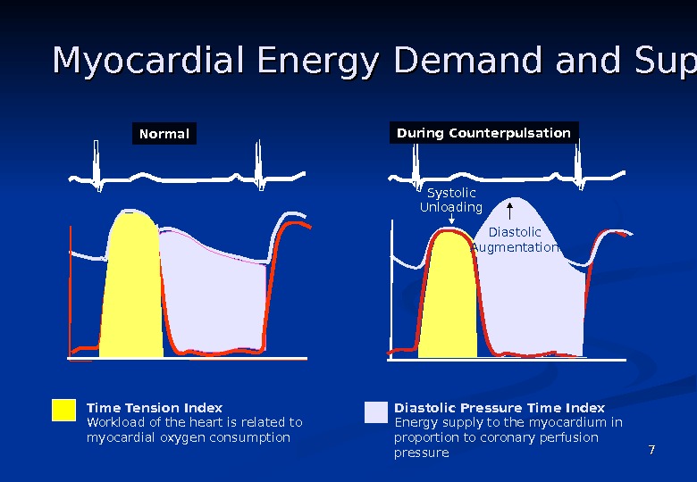 Enhanced External Counterpulsation