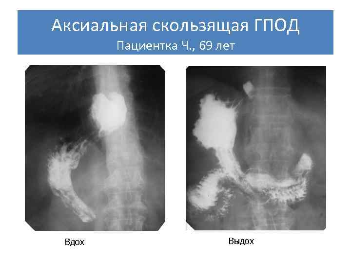 Диета При Скользящей Грыже Пищеводного Отверстия