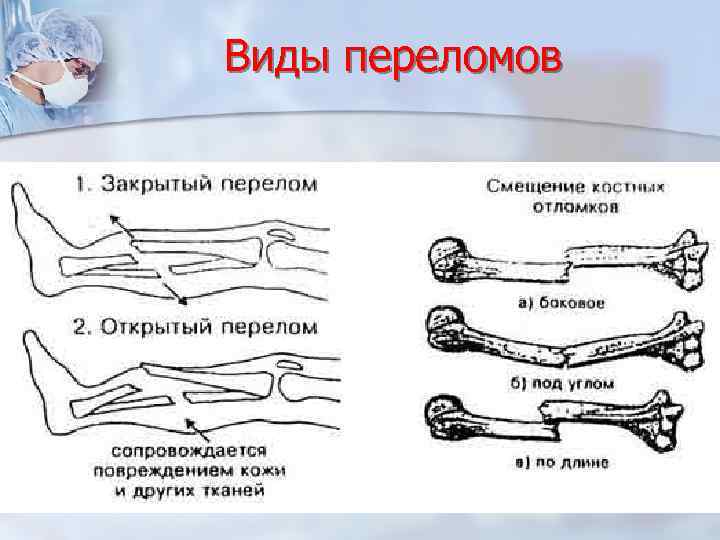 Троксерутин При Вывихах