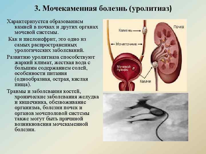 Диета При Камнях В Мочеточнике