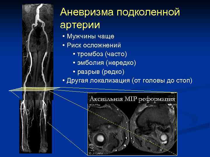 Варикозное Расширение Вен Мрт