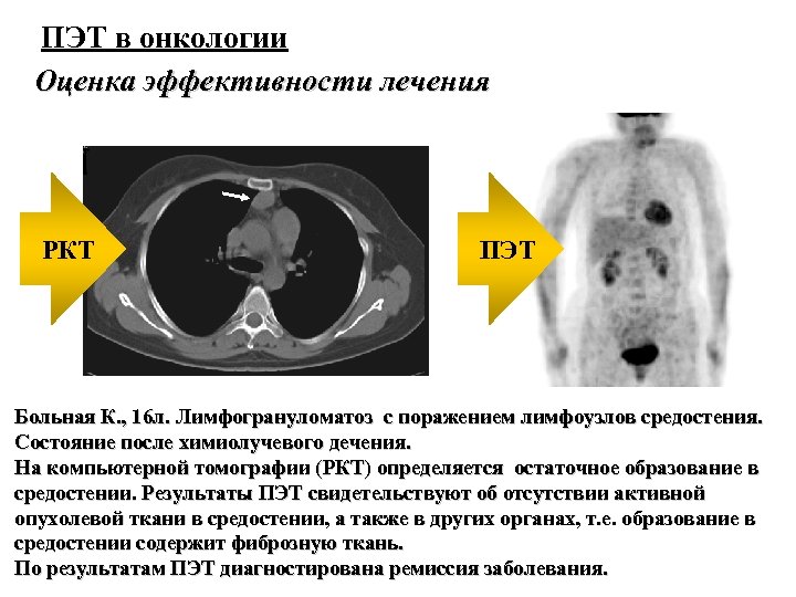 Диета При Пэт Кт Что Можно