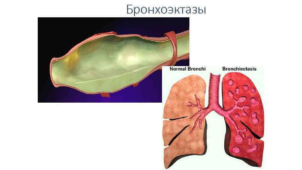 Варикозные Бронхоэктазы