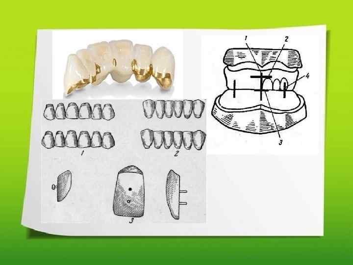 Постановка искусственных зубов на приточке