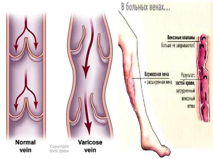 Варикозное Расширение Вен Этиология
