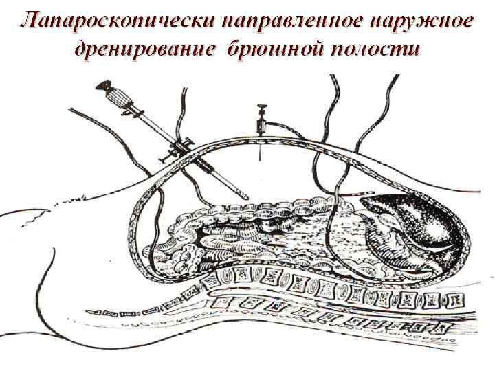 Варикоз Брюшной Полости Лечение