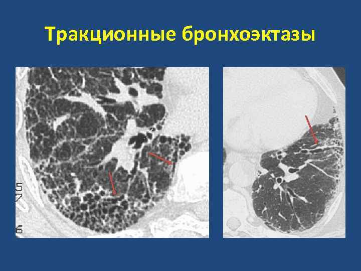 Варикозные Бронхоэктазы