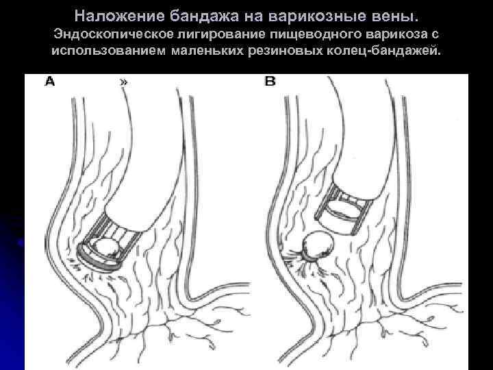 Варикоз Вен Жкт