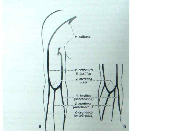 Вены Цефалика И Базилика