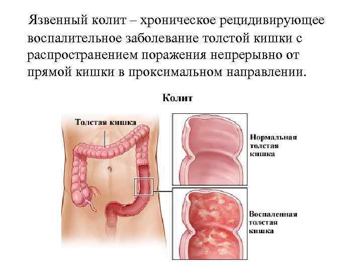 Варикоз Толстого Кишечника Симптомы