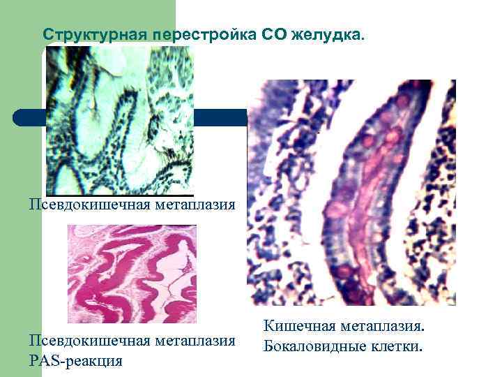 Диета При Кишечной Метаплазии