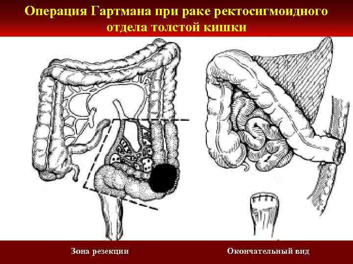 Диета При Раке Ректосигмоидного Отдела Толстой Кишки