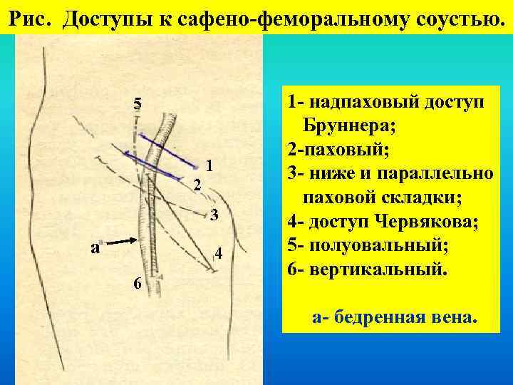 Варикозное Расширение Вен Нижних Конечностей Факультетская Хирургия