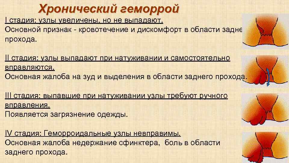 Признаки Варикоза Прямой Кишки