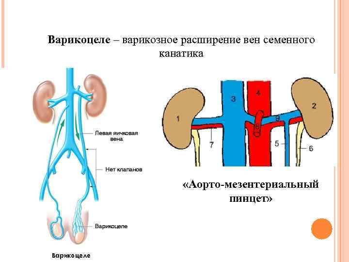 Варикозное Расширение Вен Семенного Канатика Лечение