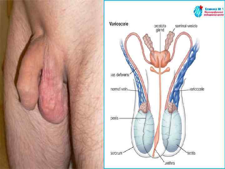 Sperm count after varicoceles surgery