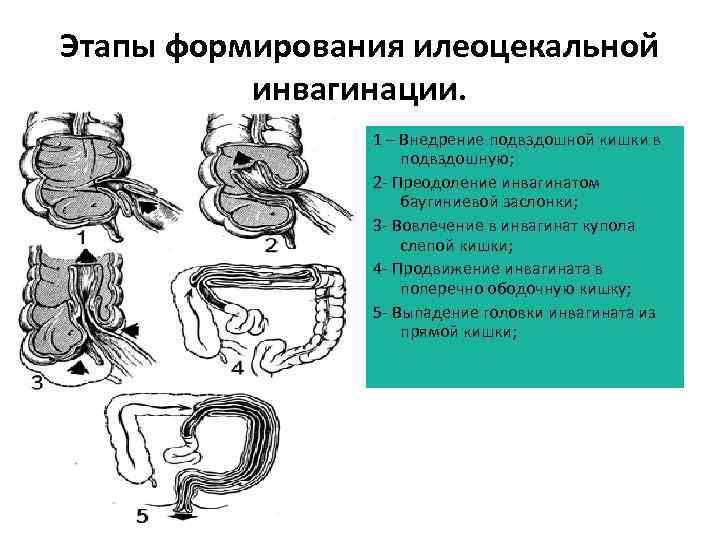 Слепая Кишка Диета