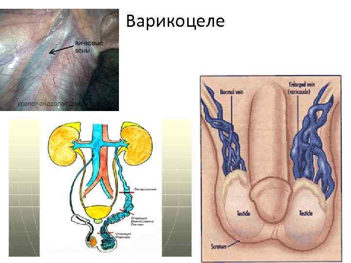 Генитальный Варикоз У Мужчин