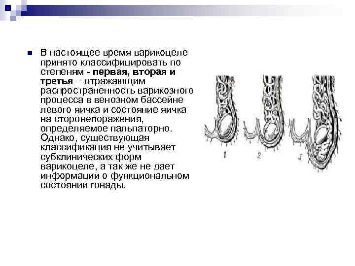 Расширение Вен Семенного Канатика Варикоцеле