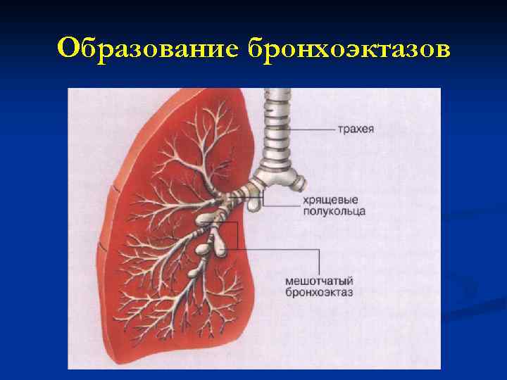 Варикозные Бронхоэктазы