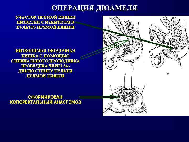 Порно Прямая Кишка Сборник