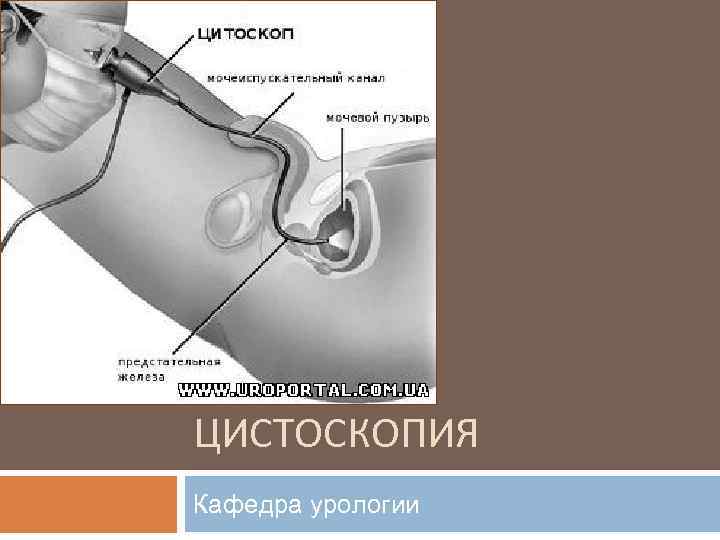 Можно Ли Заниматься Сексом После Цистоскопии