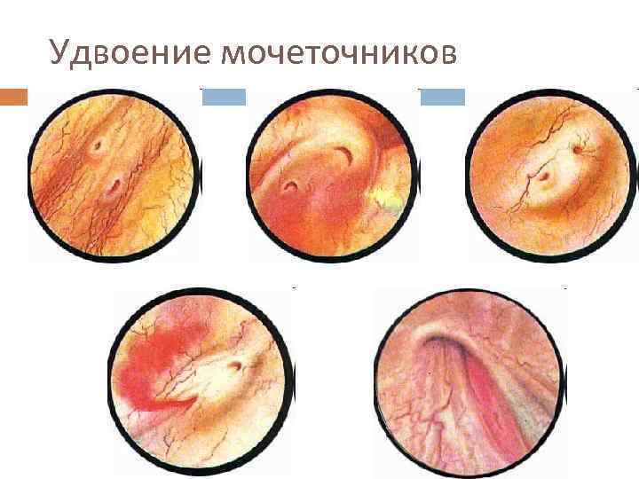 Можно Ли Заниматься Сексом После Цистоскопии