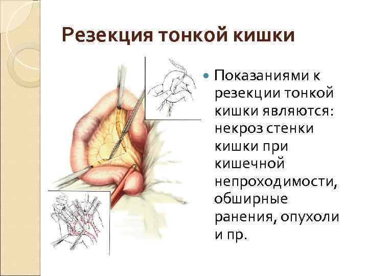 Резекция Тонкого Кишечника Послеоперационный Период Диета