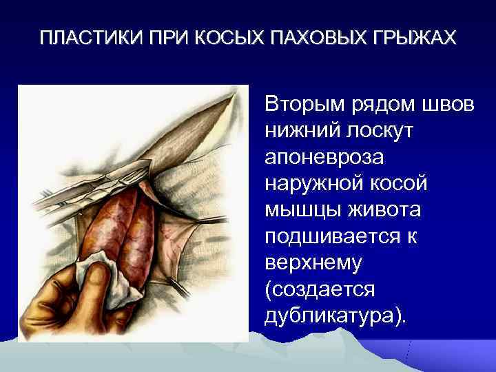 Диета При Паховой Грыже