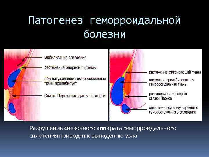 Этиология Варикозной Болезни