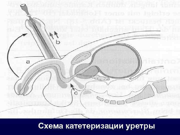 Extreme urethral fan images