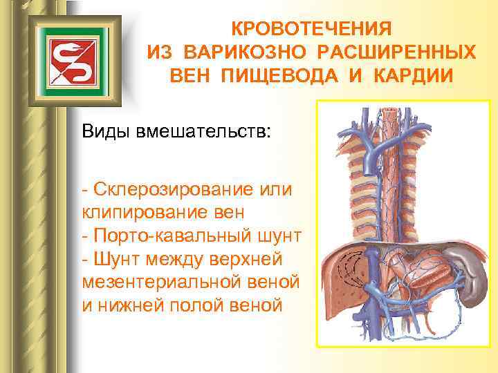 Варикозное Расширение Пищевода 2 Степени