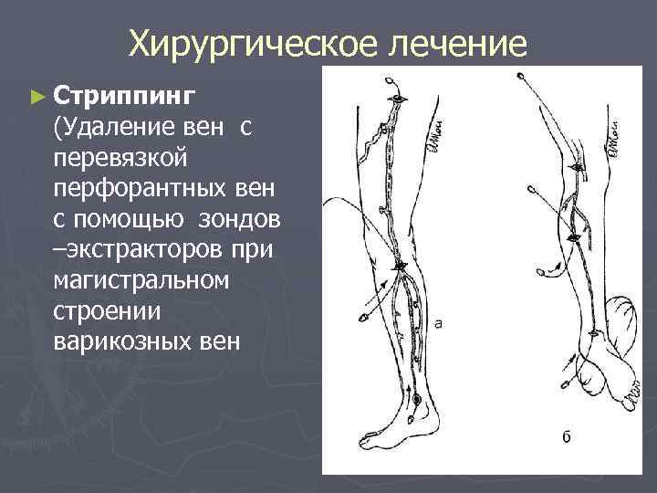 Варикоз Хирургическое Лечение Отзывы