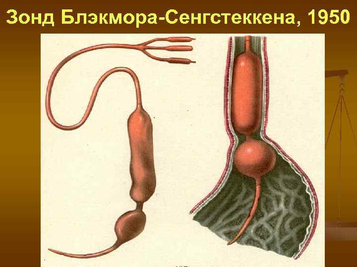 Кровотечение Из Пищевода Варикозное При Циррозе