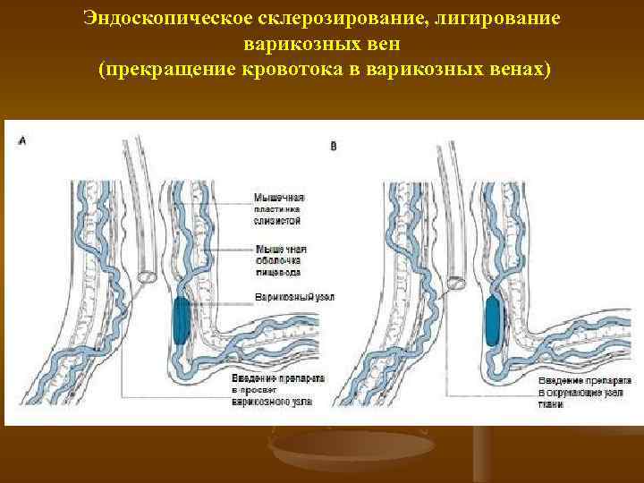 Варикозное Расширение Вен В Желудке