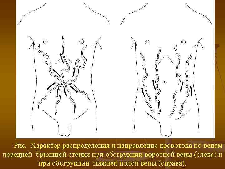 Варикоз Вен Брюшной Стенки