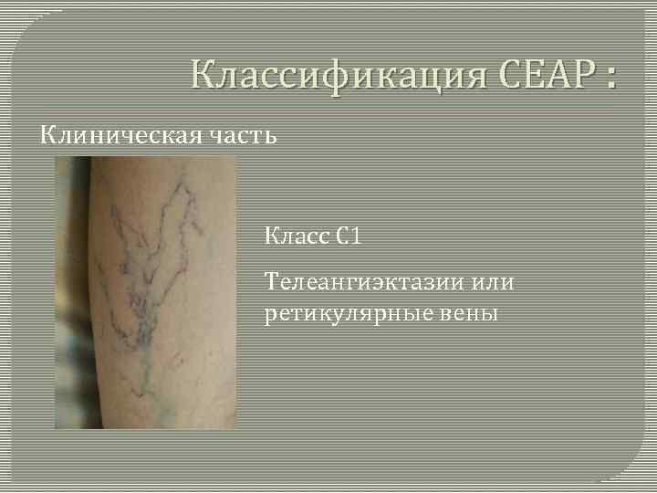 Варикоз Ceap