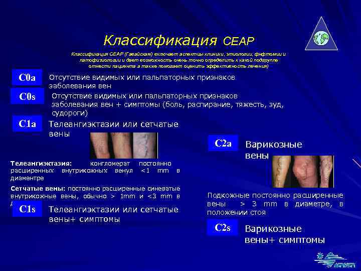 Варикоз 1 Класс