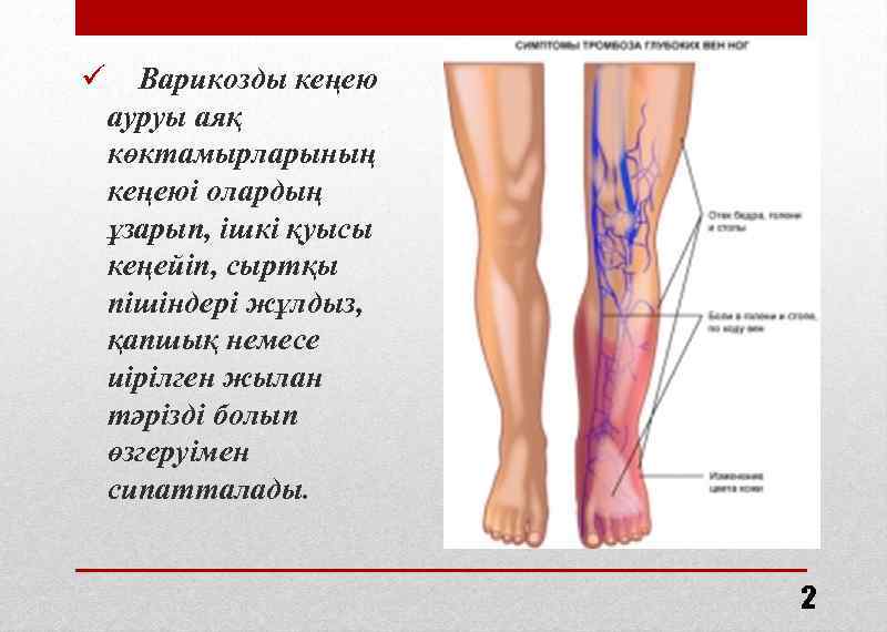 Варикозды Емдеу Жолдары