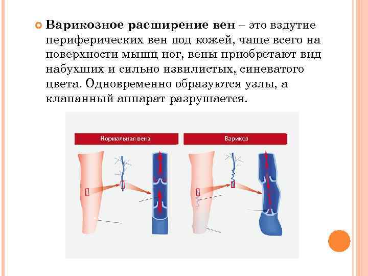 Варикозное Расширение Вен Гортани