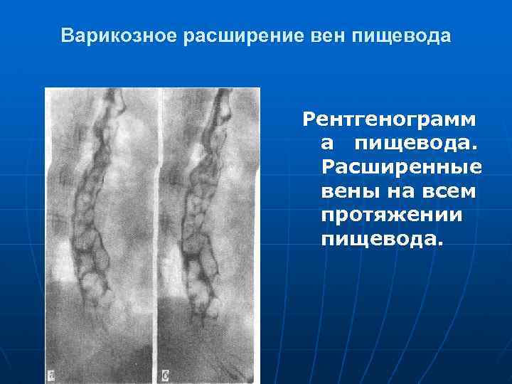 Диета При Варикозе Пищевода 3 Степени