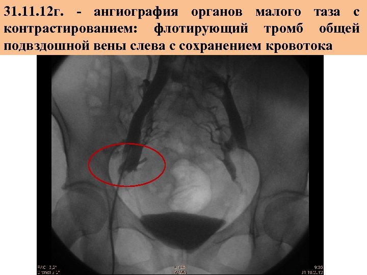 Варикозное Расширение Вен Омт