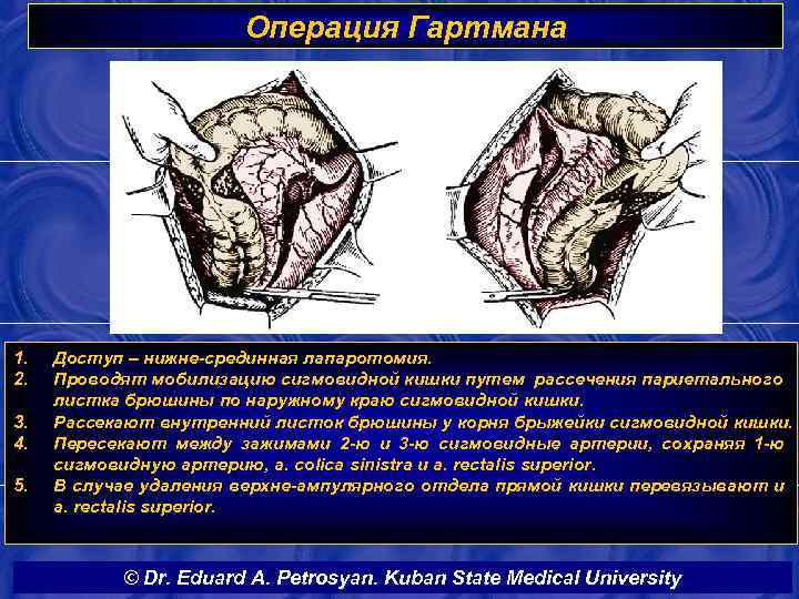 Операция На Сигмовидной Кишке Диета