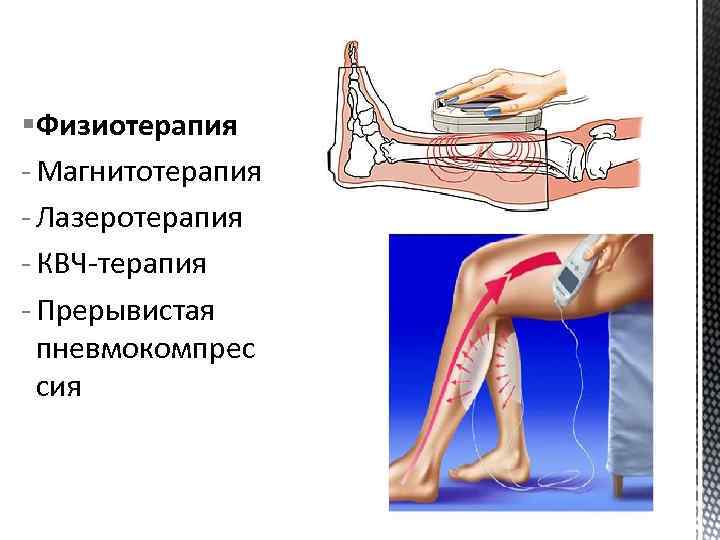 Варикоз Физиотерапия