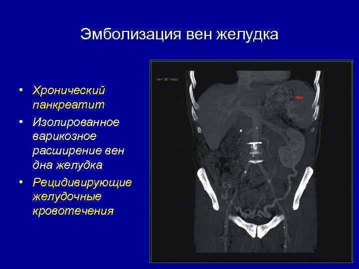 Варикоз Вен Жкт