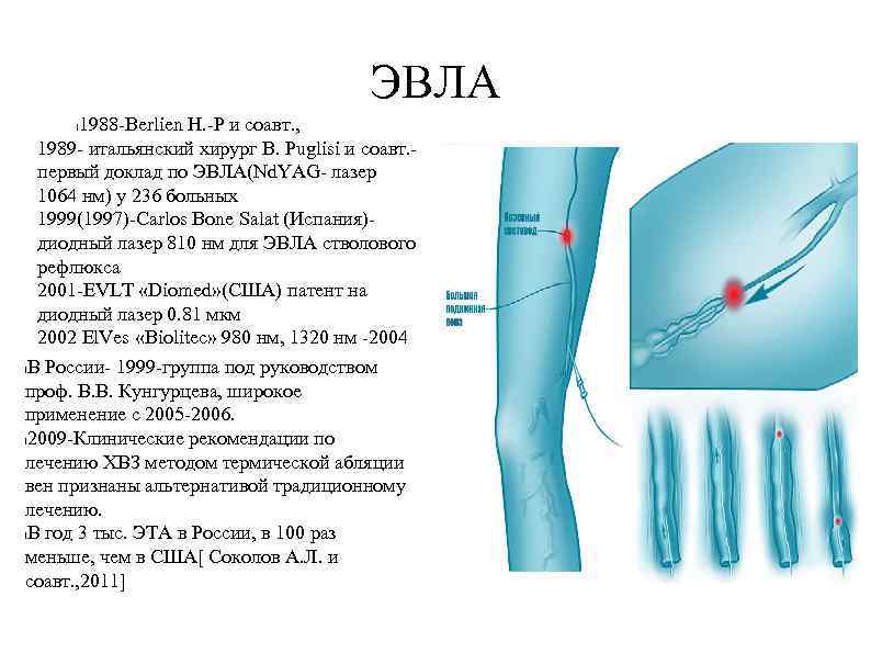 Варикоз Лечение Эвлк Отзывы